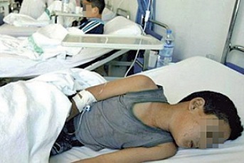  أولاد عمران: وفاة طفلان اثر إصابتهما بمرض المينانجيت